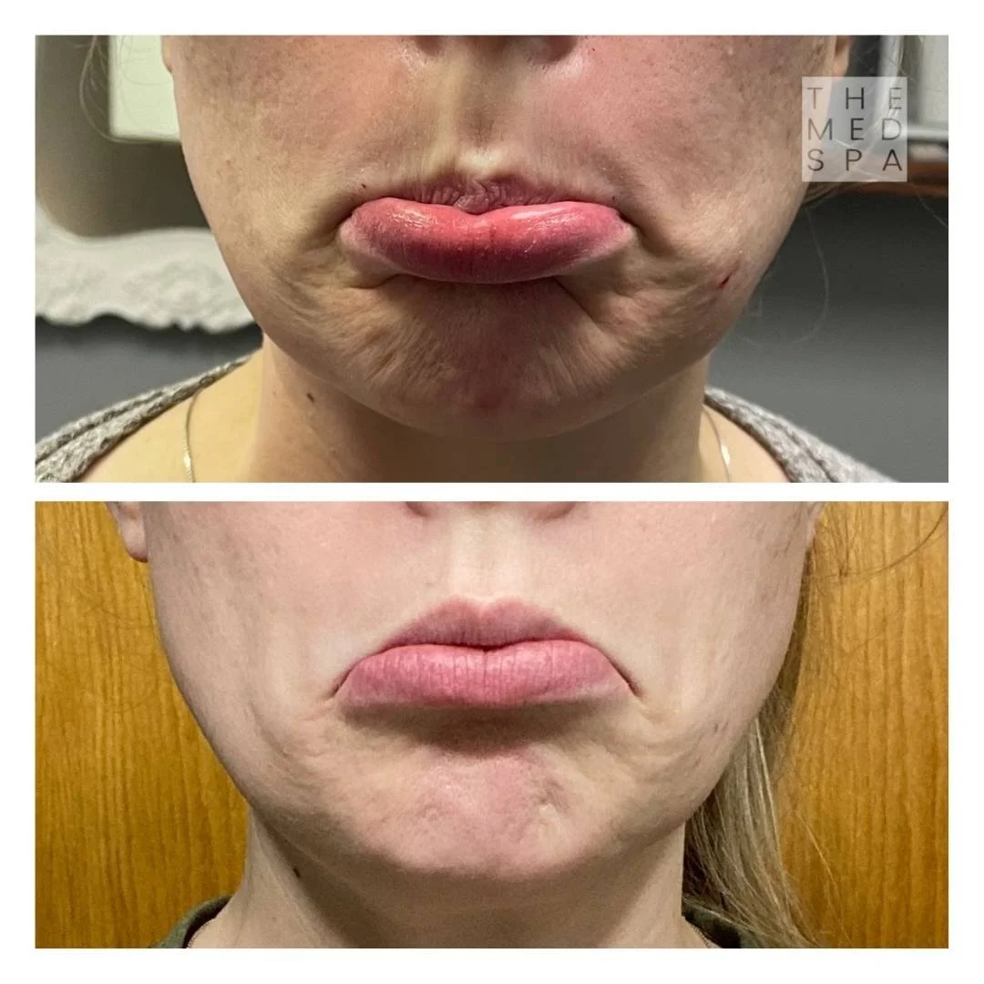 Botox to correct chin wrinkles before and after results in Woodbury, MN.