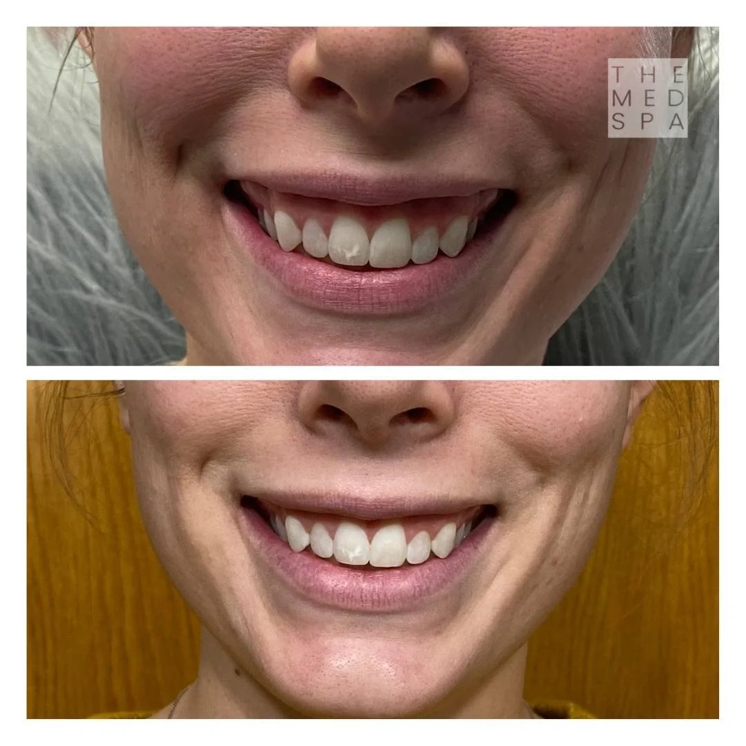 Botox for gummy smile before and after results in Woodbury, MN. Address big gums with Botox in Woodbury.