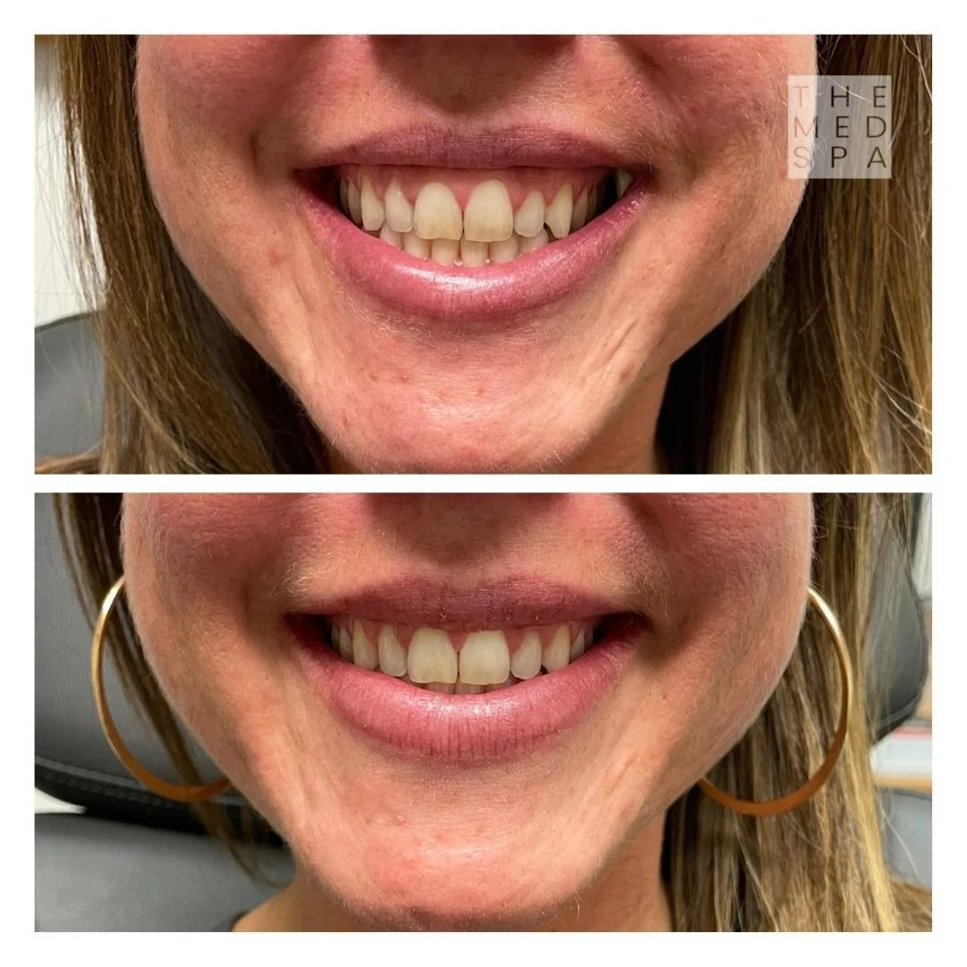 Address big gums and gummy smile with Botox in Woodbury, MN. Before and after for gummy smile with Botox.