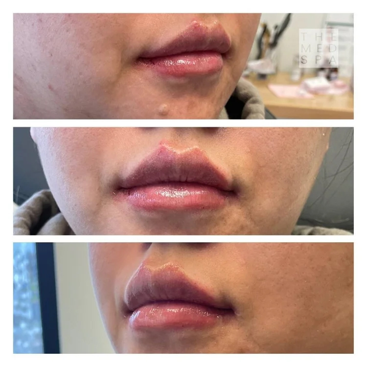 Heart shaped lip filler before and after results in Woodbury, MN.