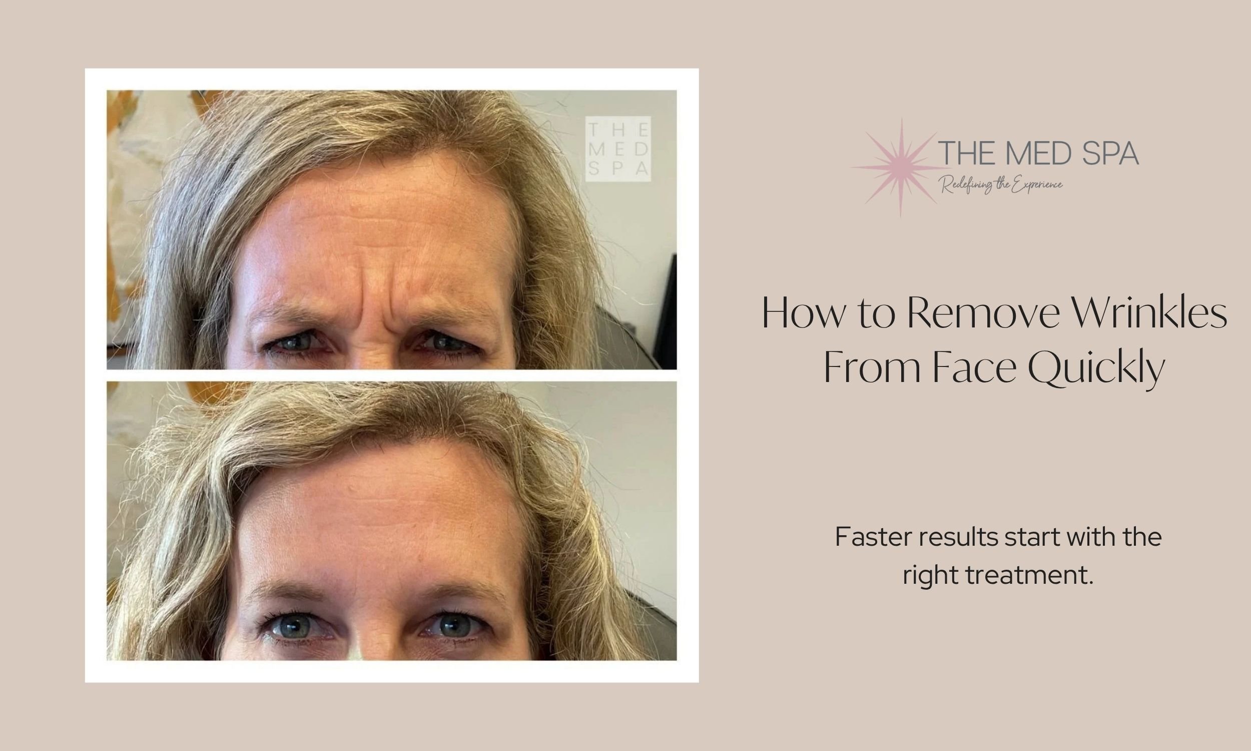 How to Remove Wrinkles From Face Quickly