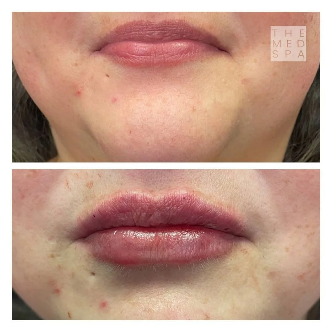 Lip filler results with Revanesse lip fillers in Woodbury, MN.