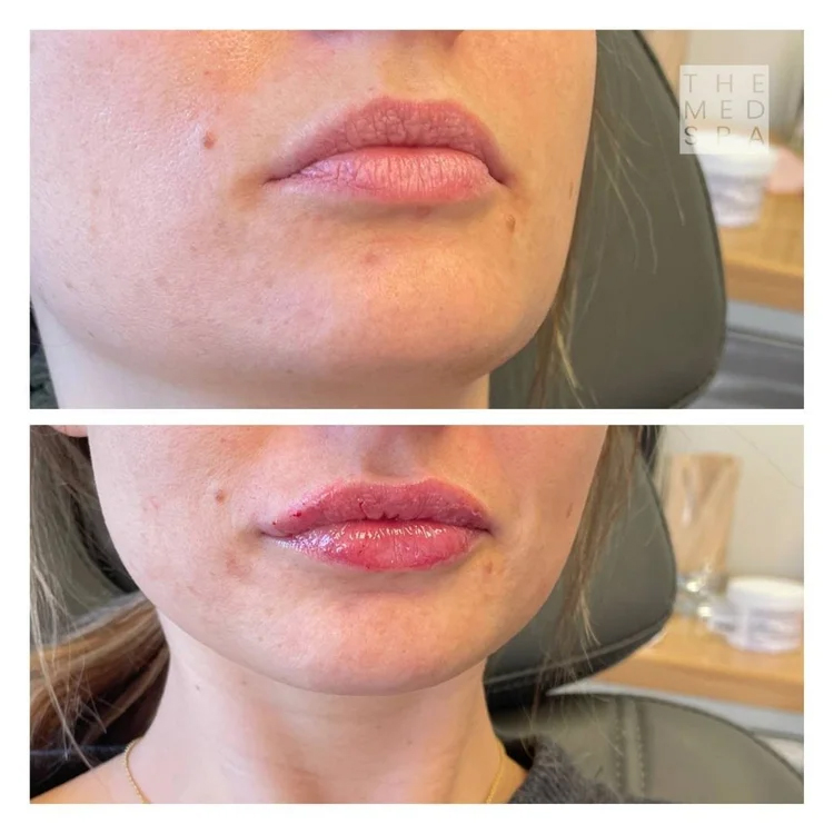 Beautiful lip filler before and afters in Woodbury, MN by Aesthetic Nurse Injector, Hollie Laney.