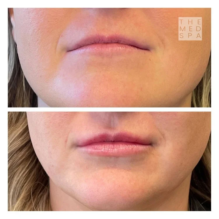 Small lips natural results with fillers near Woodbury, MN. Medspa offering natural lip filler results.