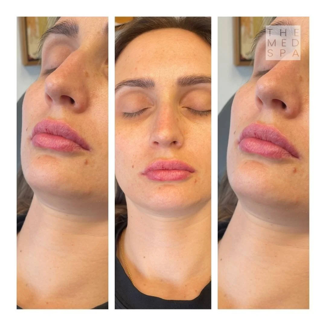 Fillers for lip volume before and afters in Woodbury, MN.
