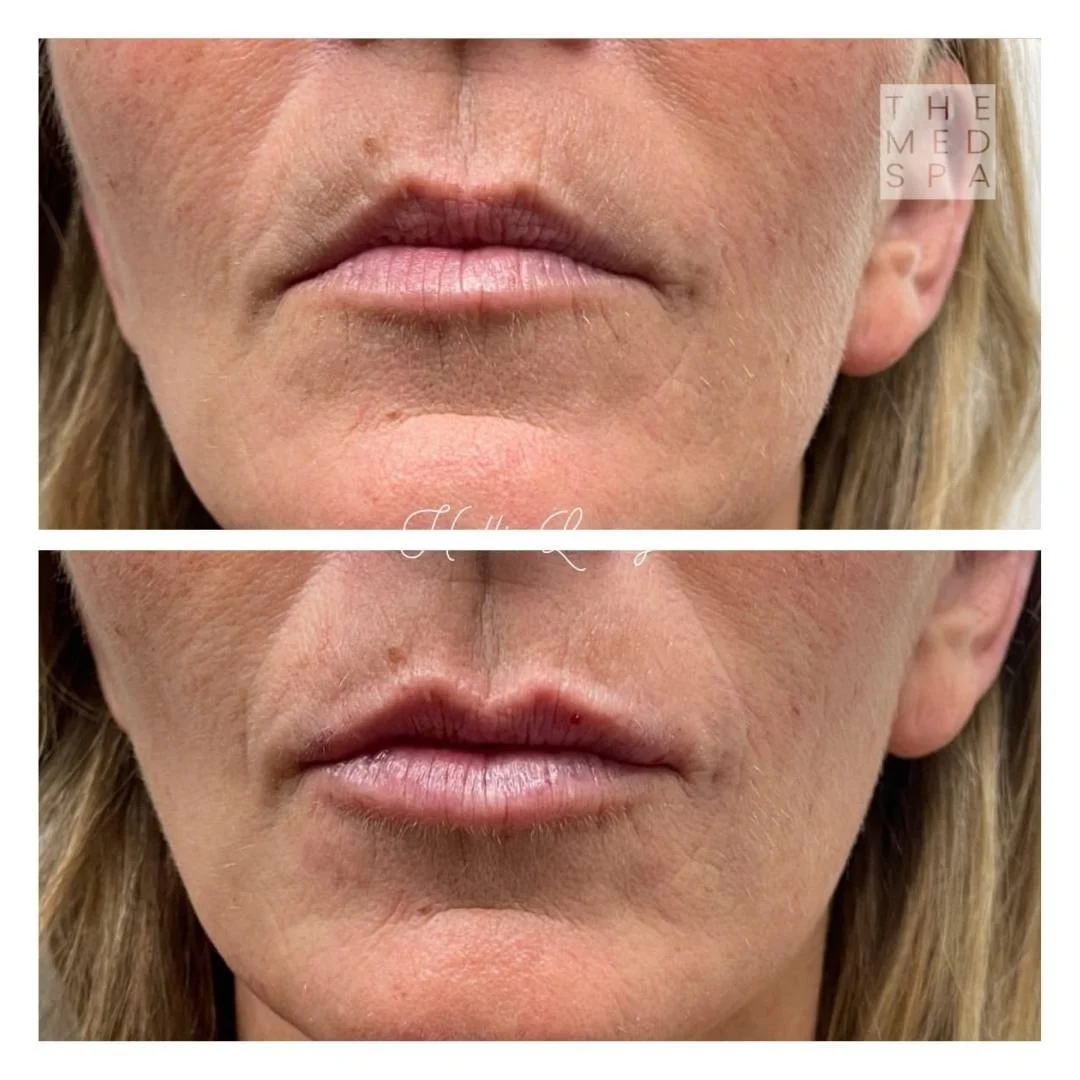 Revanesse lip filler results for fine lines and volume in Woodbury, MN. Revanesse lip filler before and afters for women.
