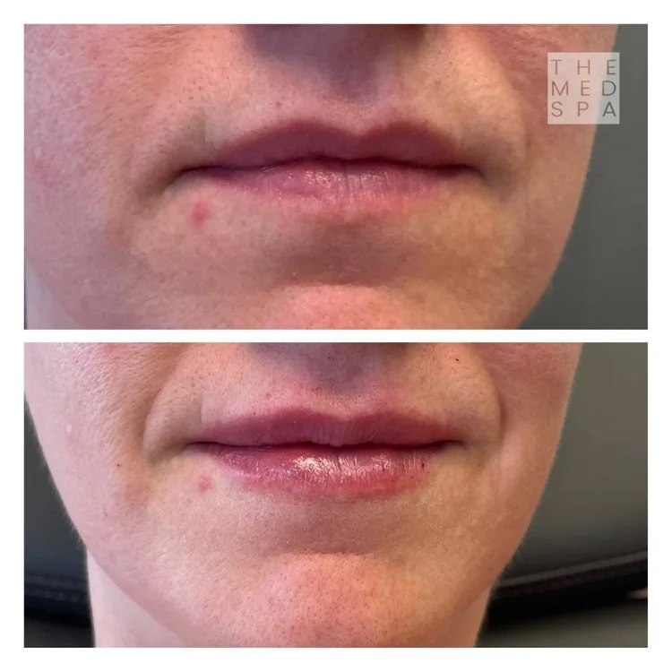 Lip filler for symmetry before and after patient results in Woodbury, MN.