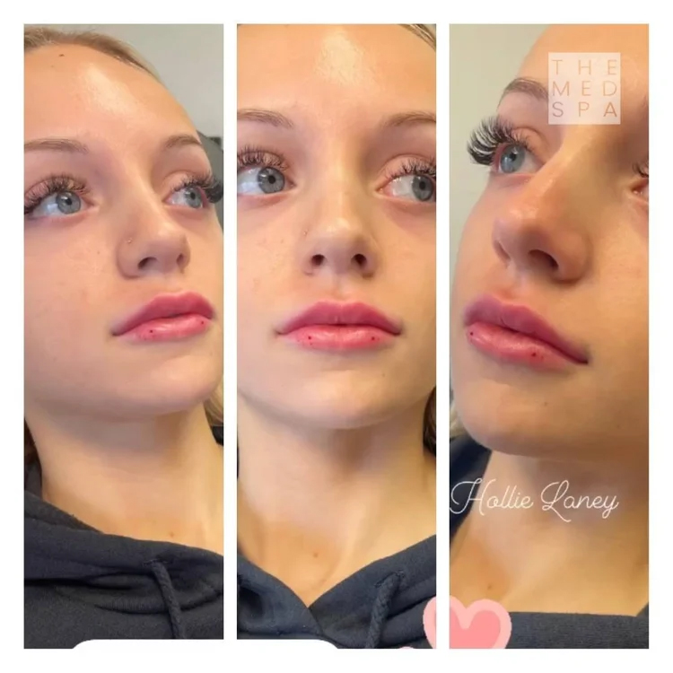 Revanesse lip filler before and after results in Woodbury, MN.