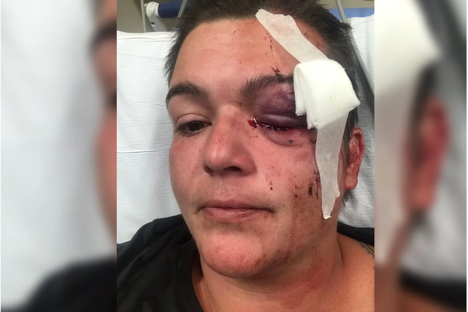 United States: Police Fired Rubber Bullets, Leaving Journalist Linda Tirado Permanently Blind.