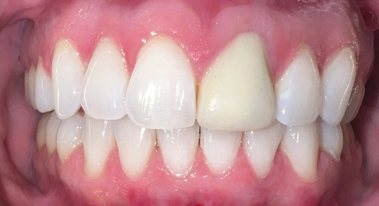 {Before} Pt desired a more aesthetic #9 crown after Whitening