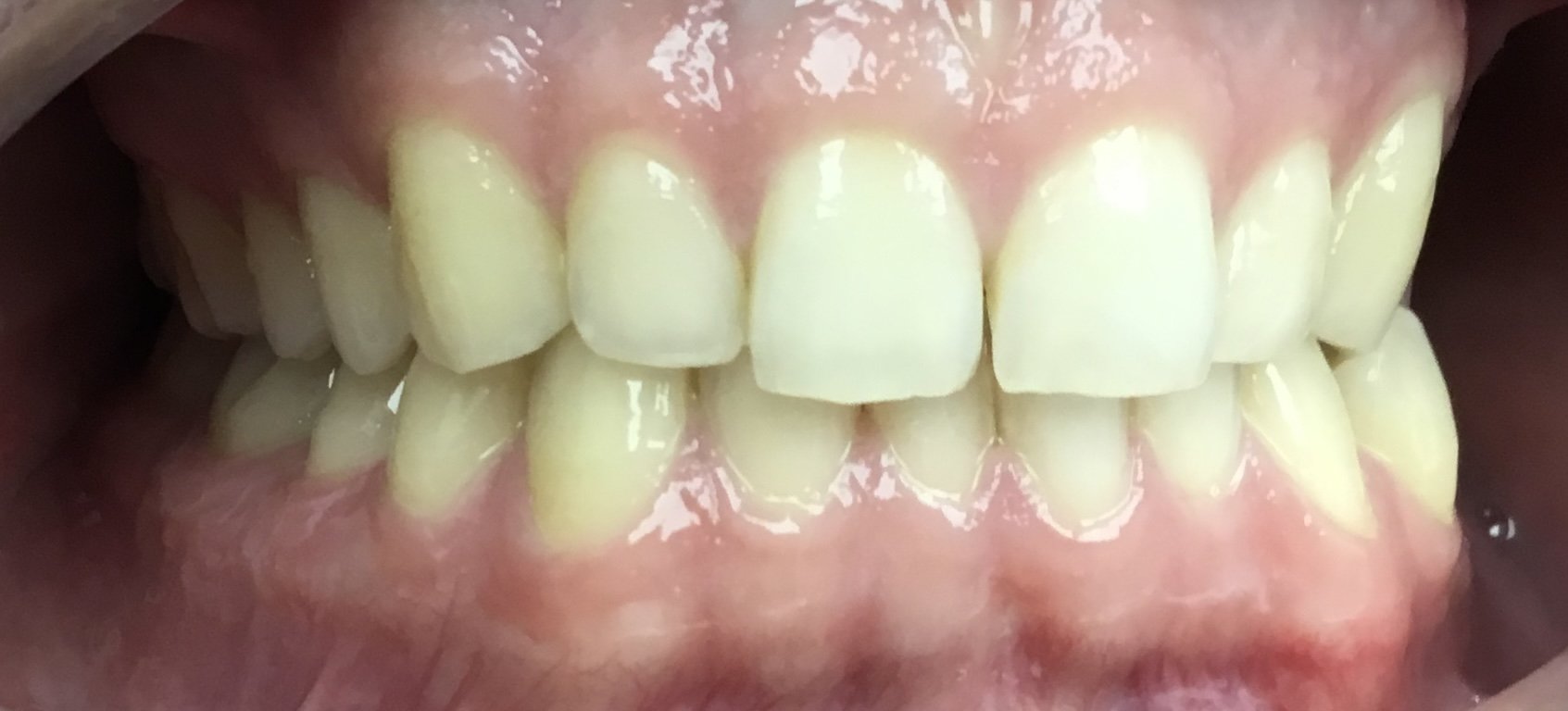 {Before} Invisalign - Patient E. M.