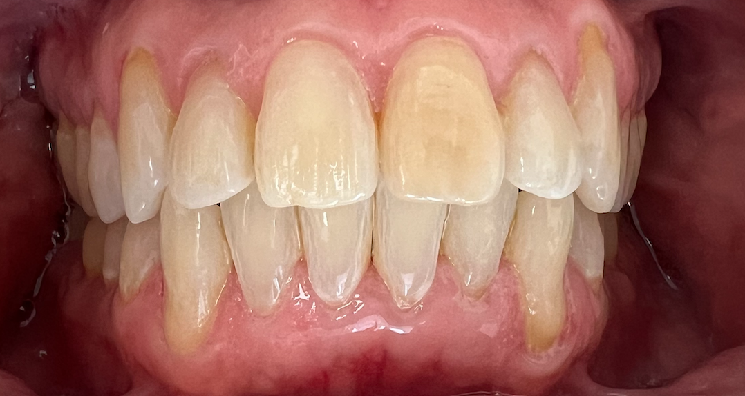 {After Invisalign}
