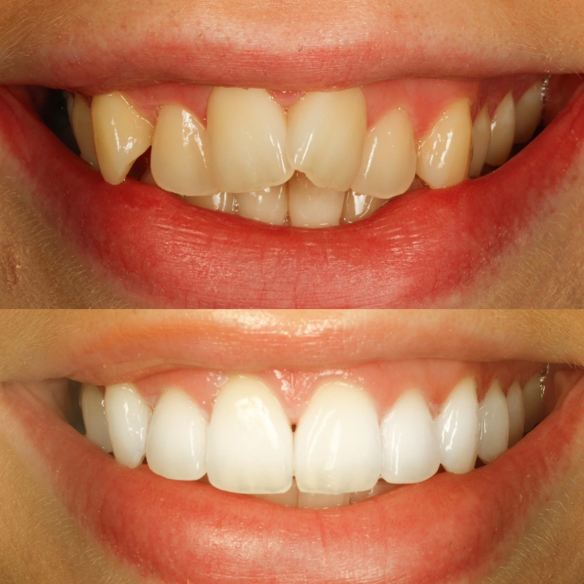 Cost invisalign sheffield clear braces. Complex package Invisalign teeth straighteing before and after.