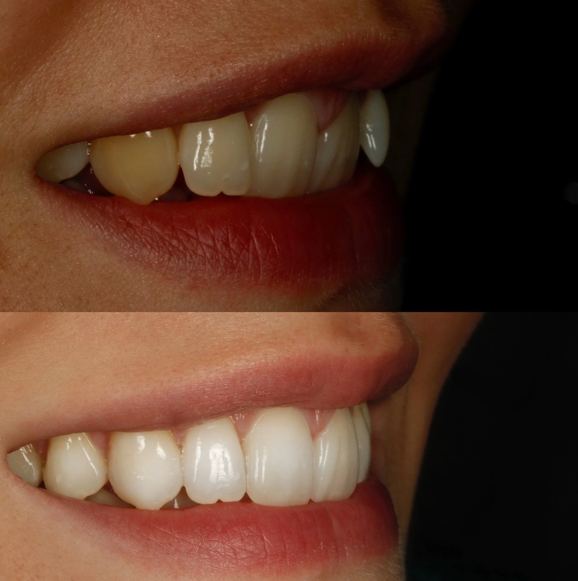 Cost of invisalign single arch teeth straightening at Sheffield clear braces
