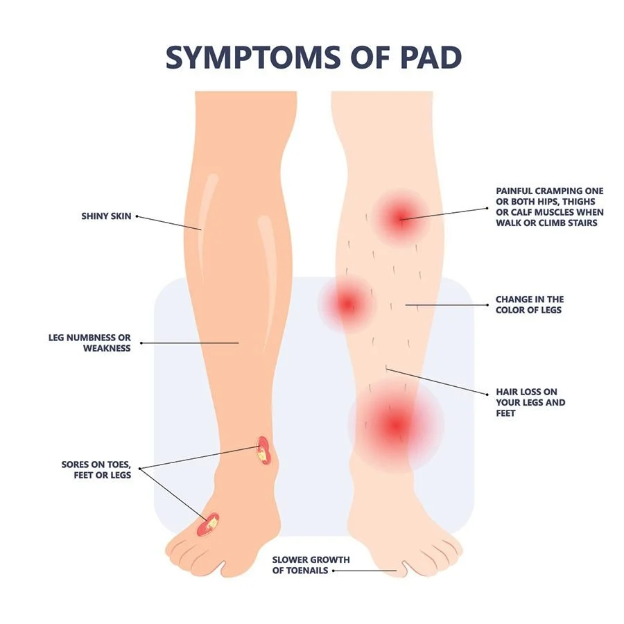 Peripheral Artery Disease (PAD)