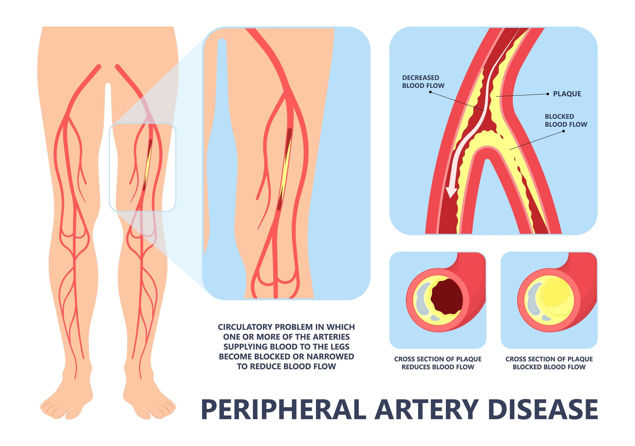 Blocked artery in leg symptoms online