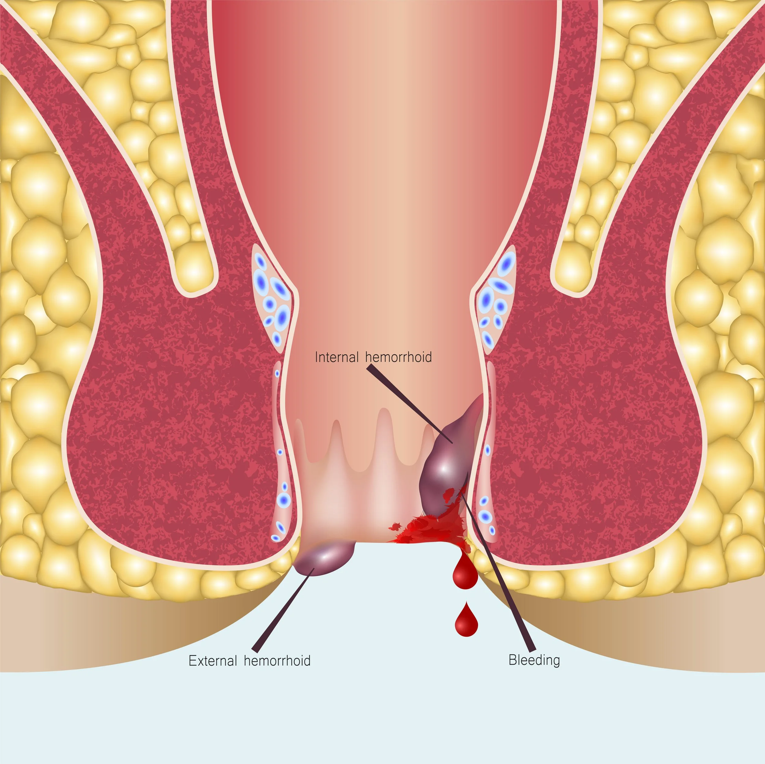 internal hemorrhoids illustration