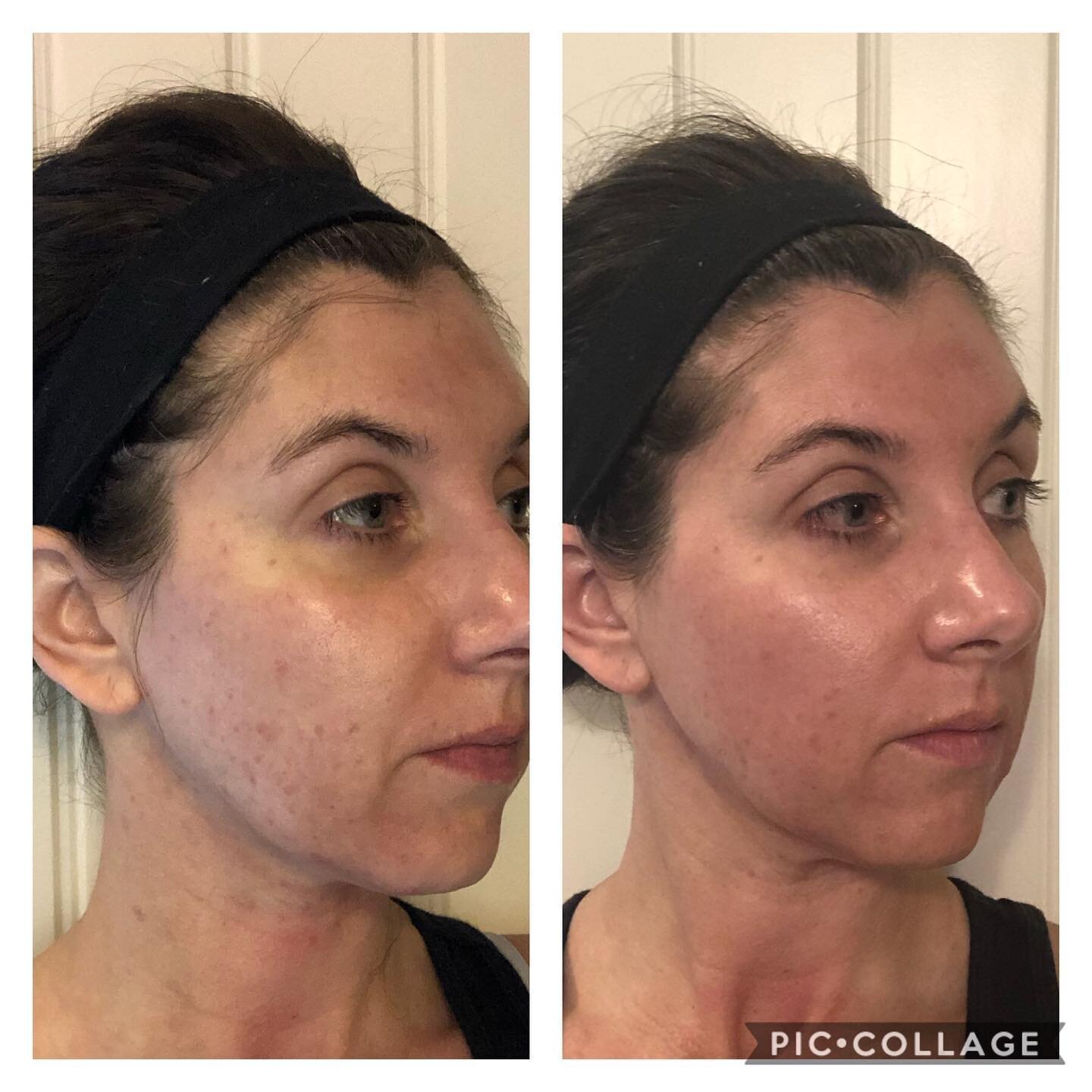 Check it out! Before and one week after microneedling with a peel! Stay tuned for more information on Microneedling and it&rsquo;s incredible benefits! We have 2 Registered Nurses trained and certified that deliver incredible results!!#microneedling#