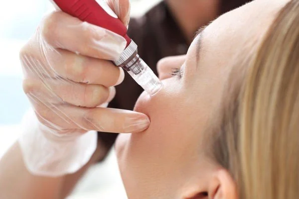 client getting PRP facelift procedure