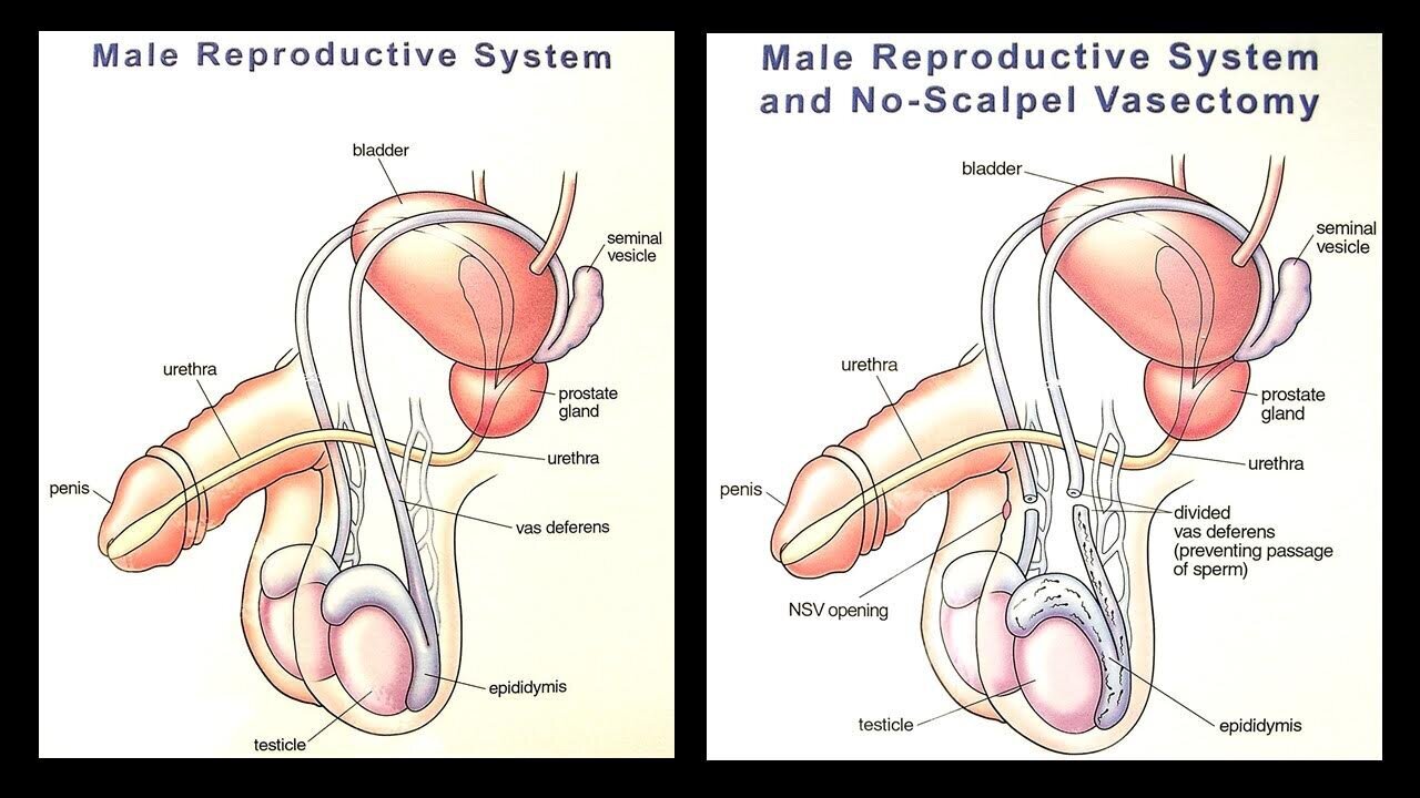 Vasectomy In In Portland Or