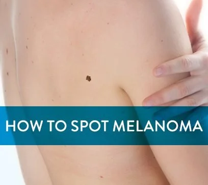 Melanoma Awareness: What You Need to Know to Protect Your Skin