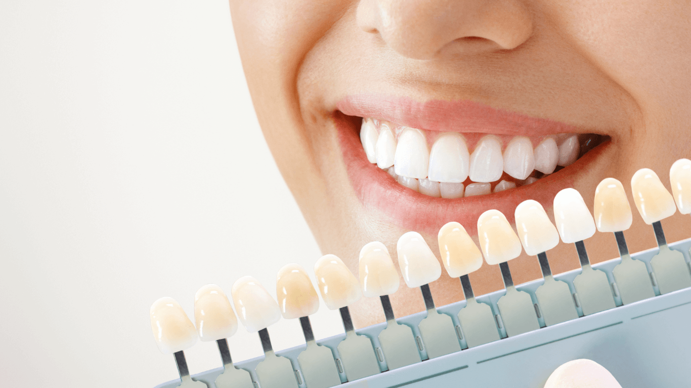 Brighter Smiles Ahead: Everything You Need to Know About Professional Teeth Whitening