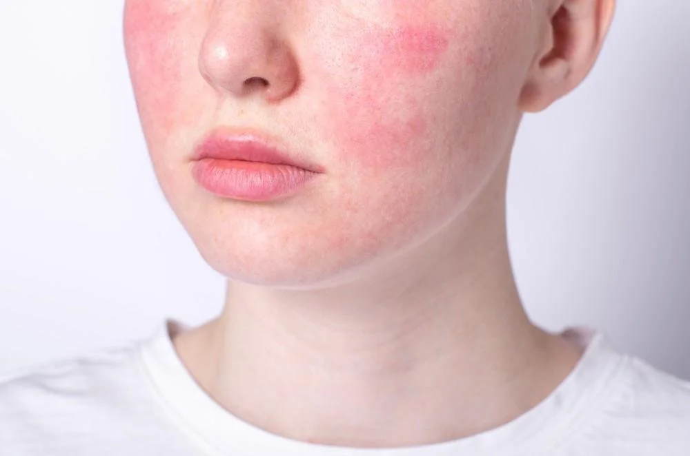 Winter Redness, Sensitivity, and Rosacea: Why Cold Weather Makes It Worse