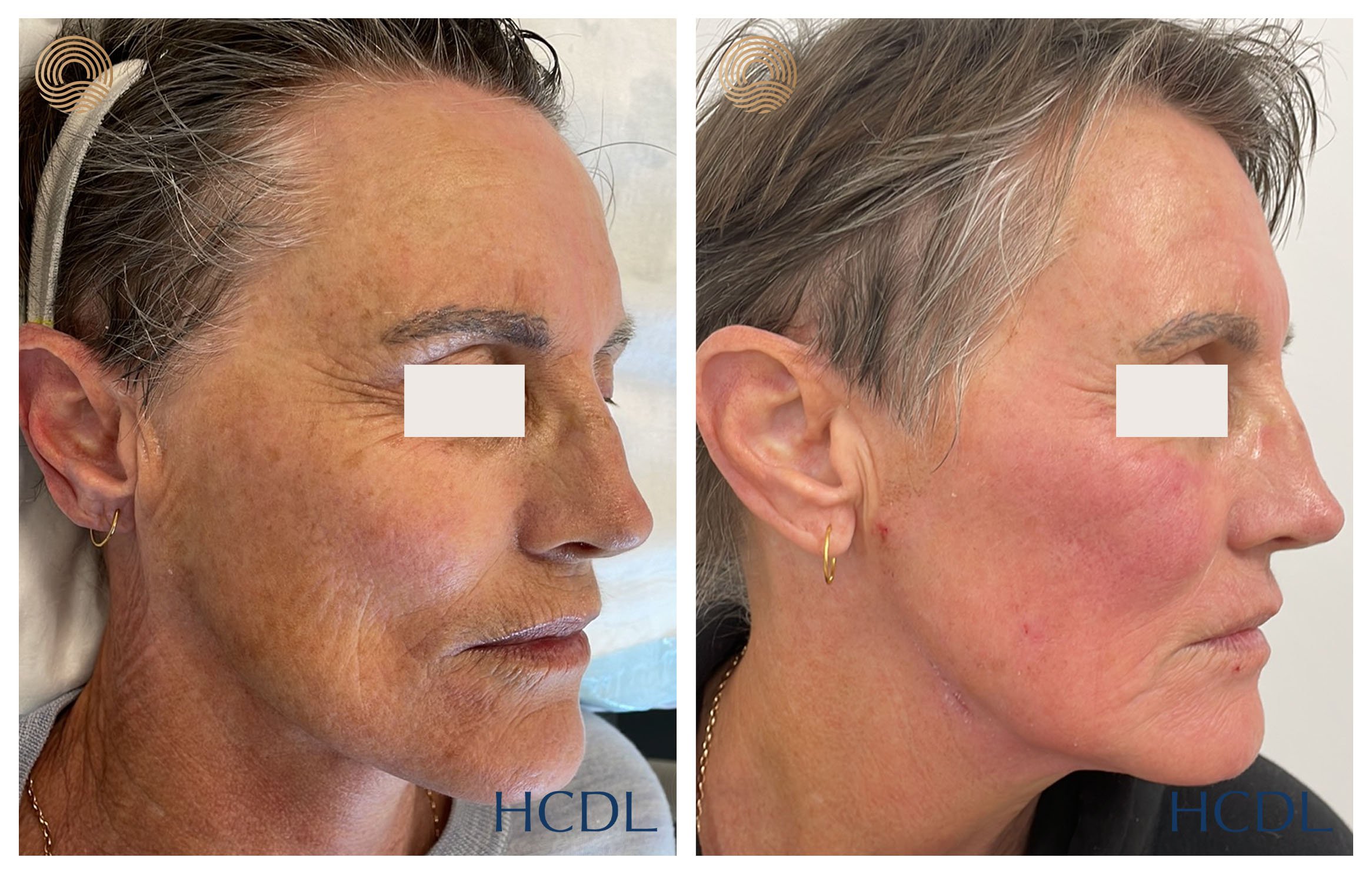 Rejuvenate your skin with our Carbon Dioxide Laser treatment, Dermatologist Led, Best in Newcastle — Hunter Coast Dermatology & Laser