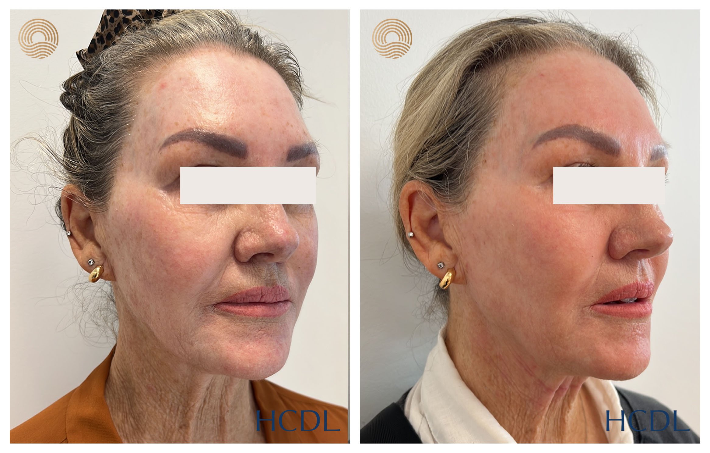 After 1 treatment with the CO2 laser resurfacing for rejuvenation.