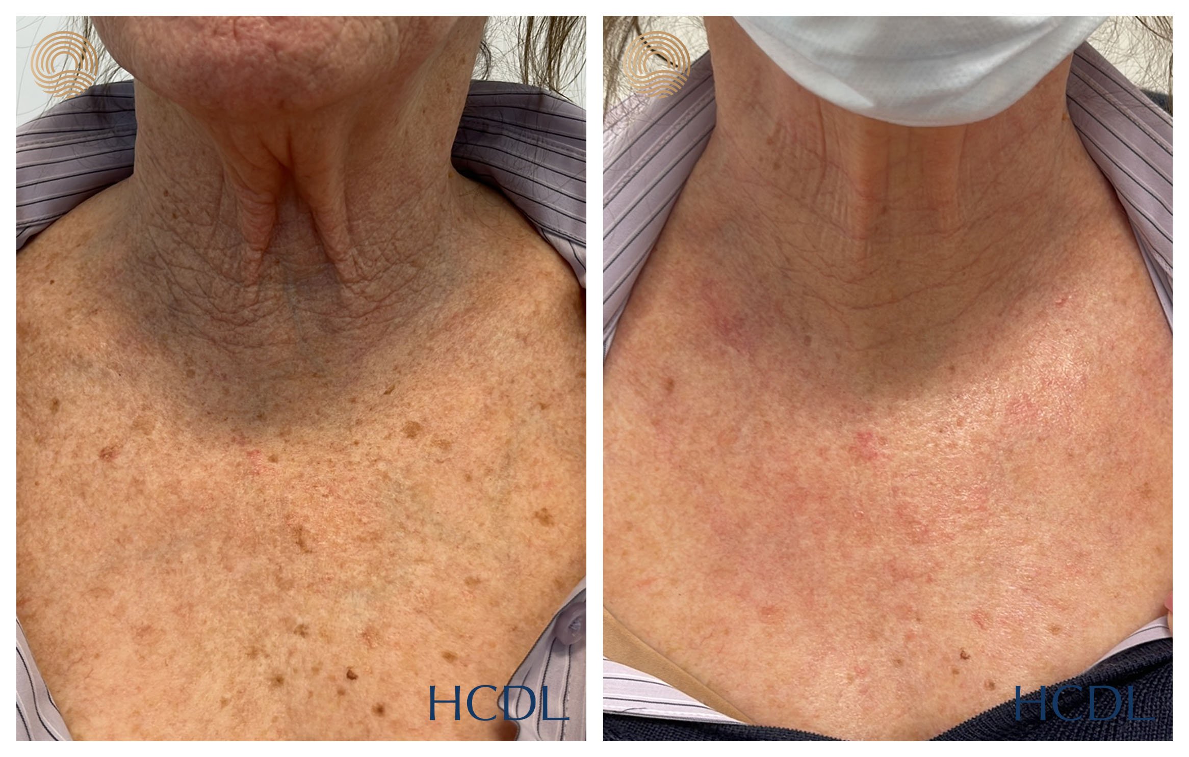 After 1 treatment with the CO2 laser resurfacing for rejuvenation.