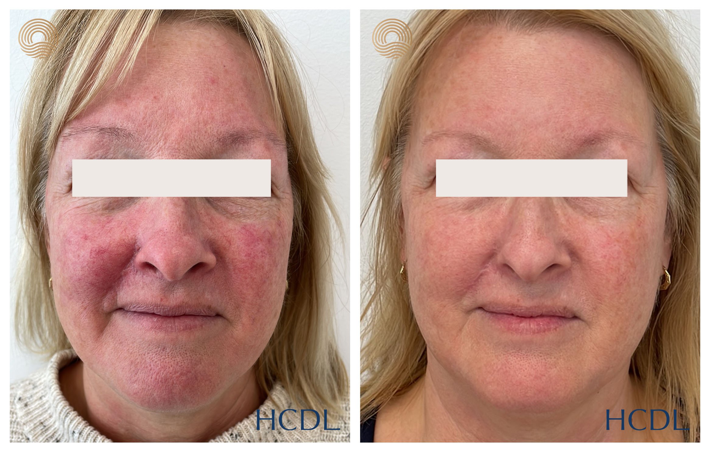Results after only 1 treatment of vascular laser.