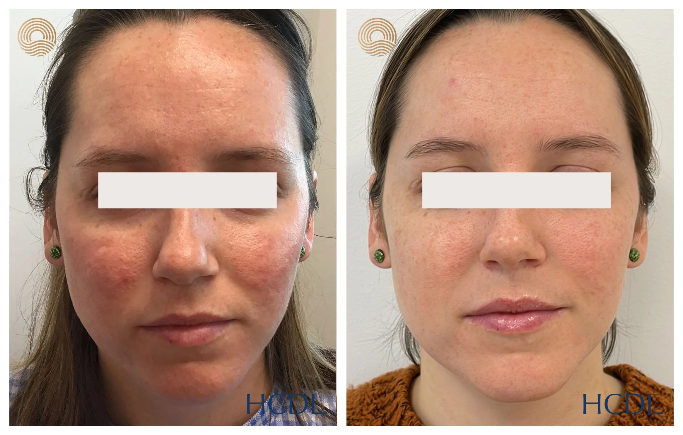 Vascular & Pigment Laser — Hunter Coast Dermatology & Laser Newcastle