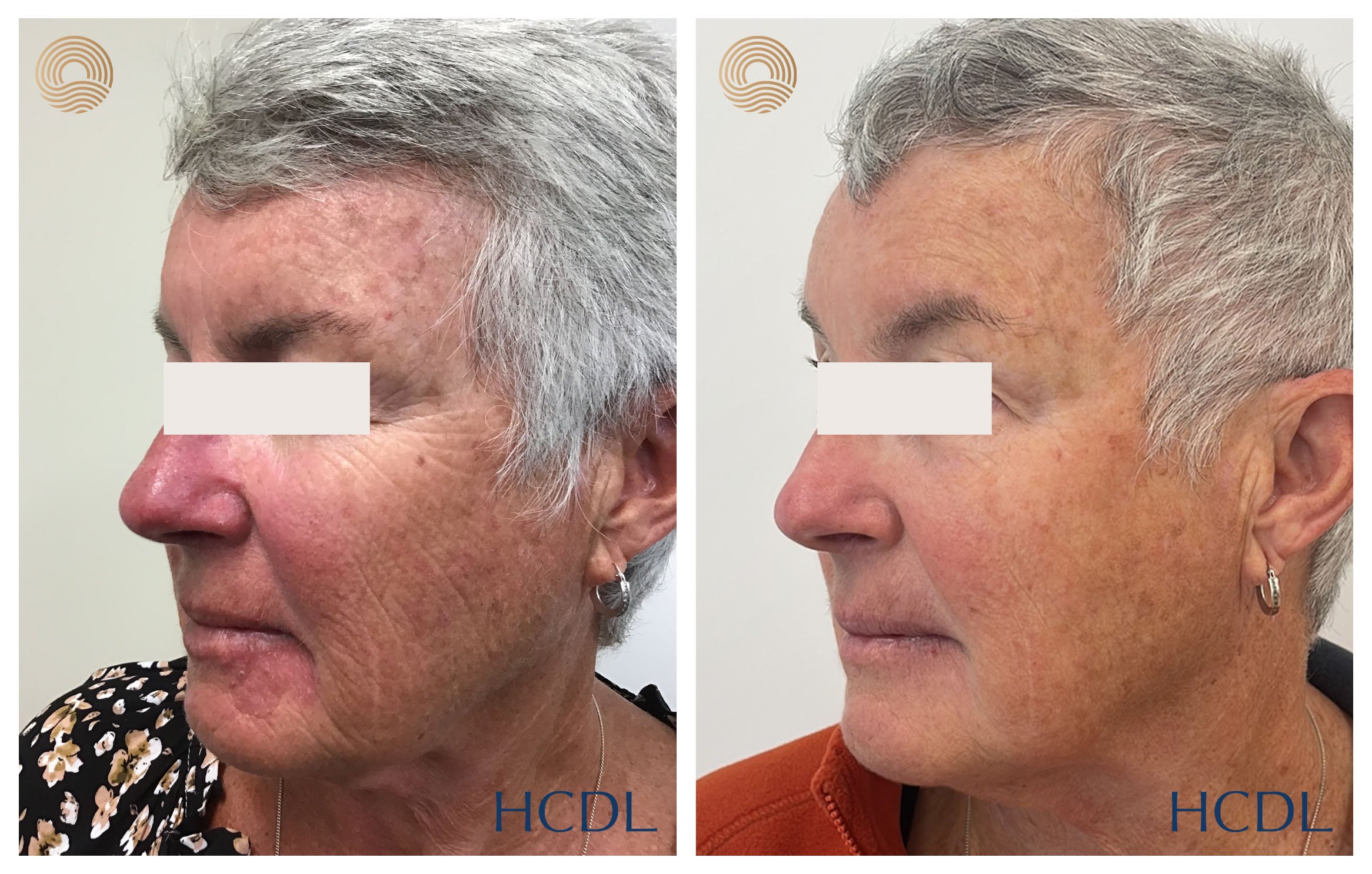 combined medical and laser management after 8 months and 3 x vascular laser treatments.