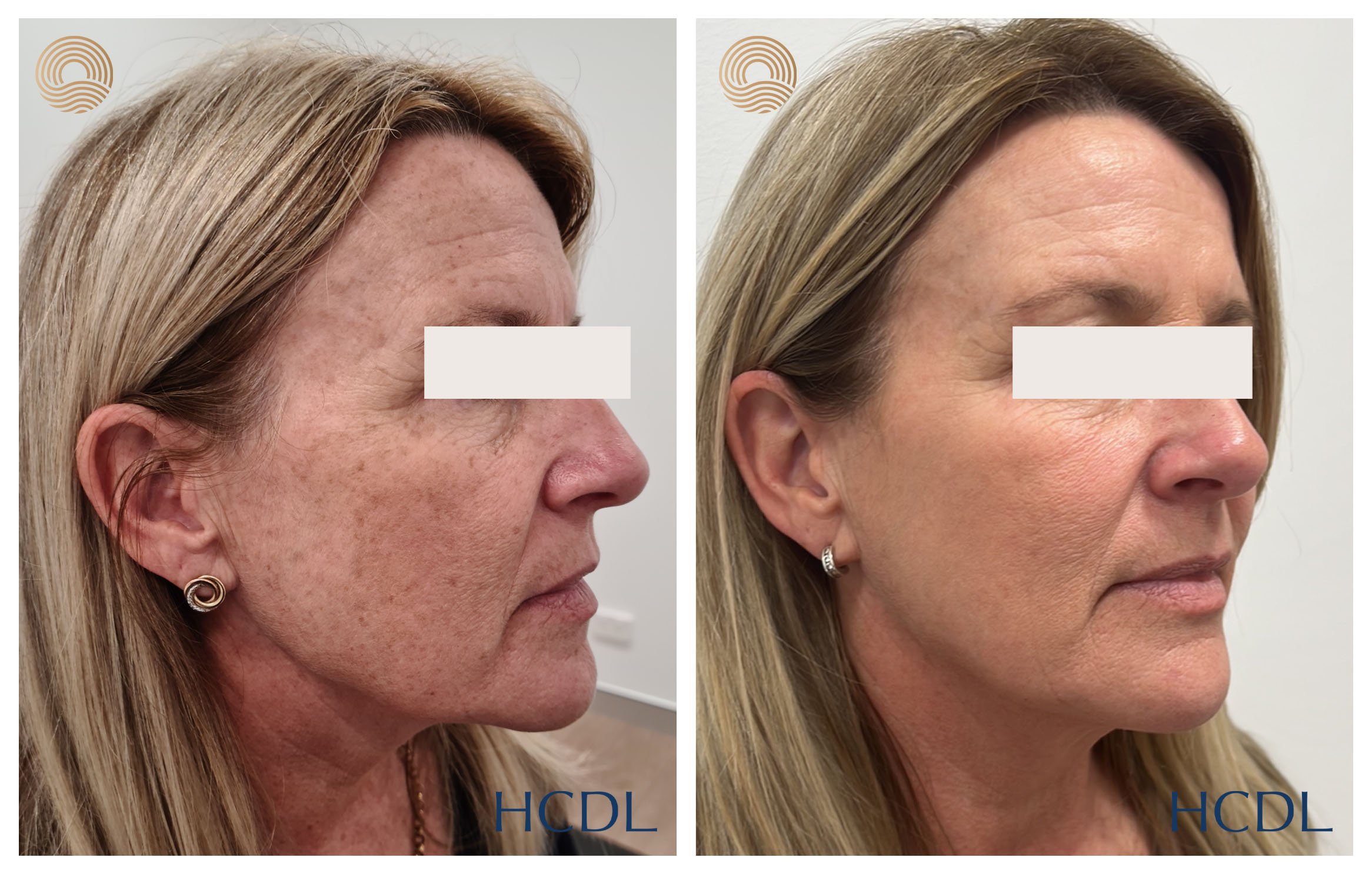 After 3 treatments of treatment with Cutera Excel V+ with a focus on pigmentation.