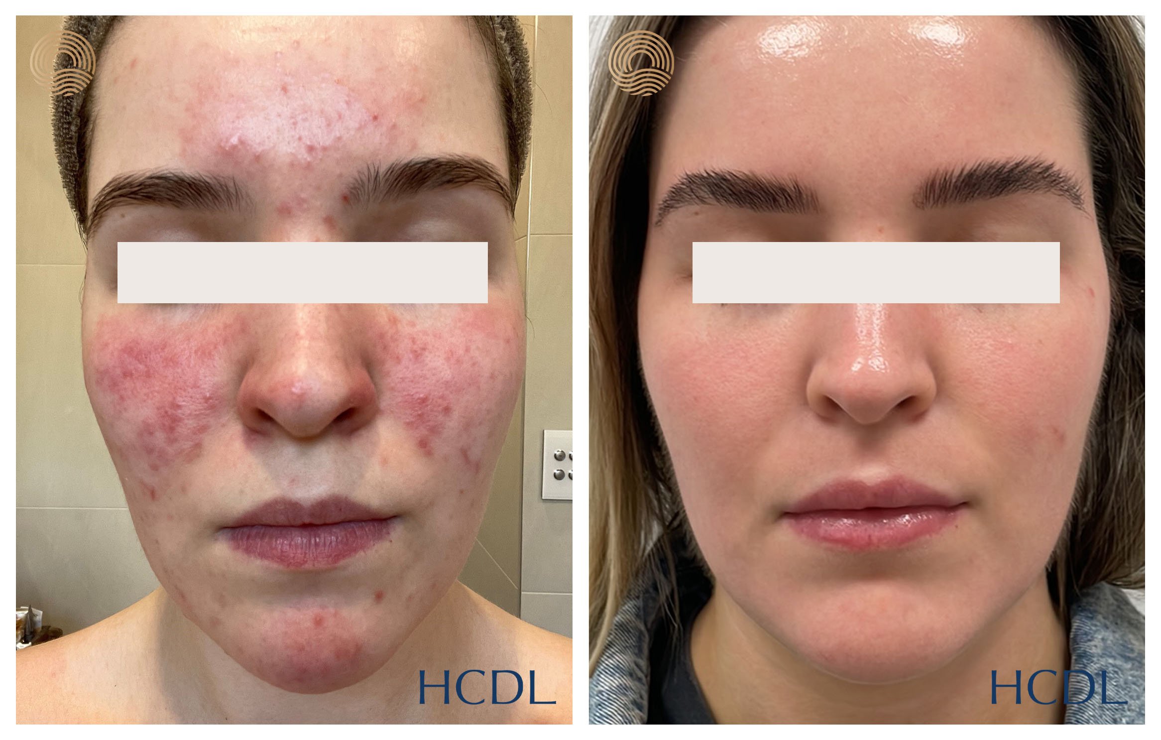Results after Medical treatment for acne and 2 vascular laser treatments.
