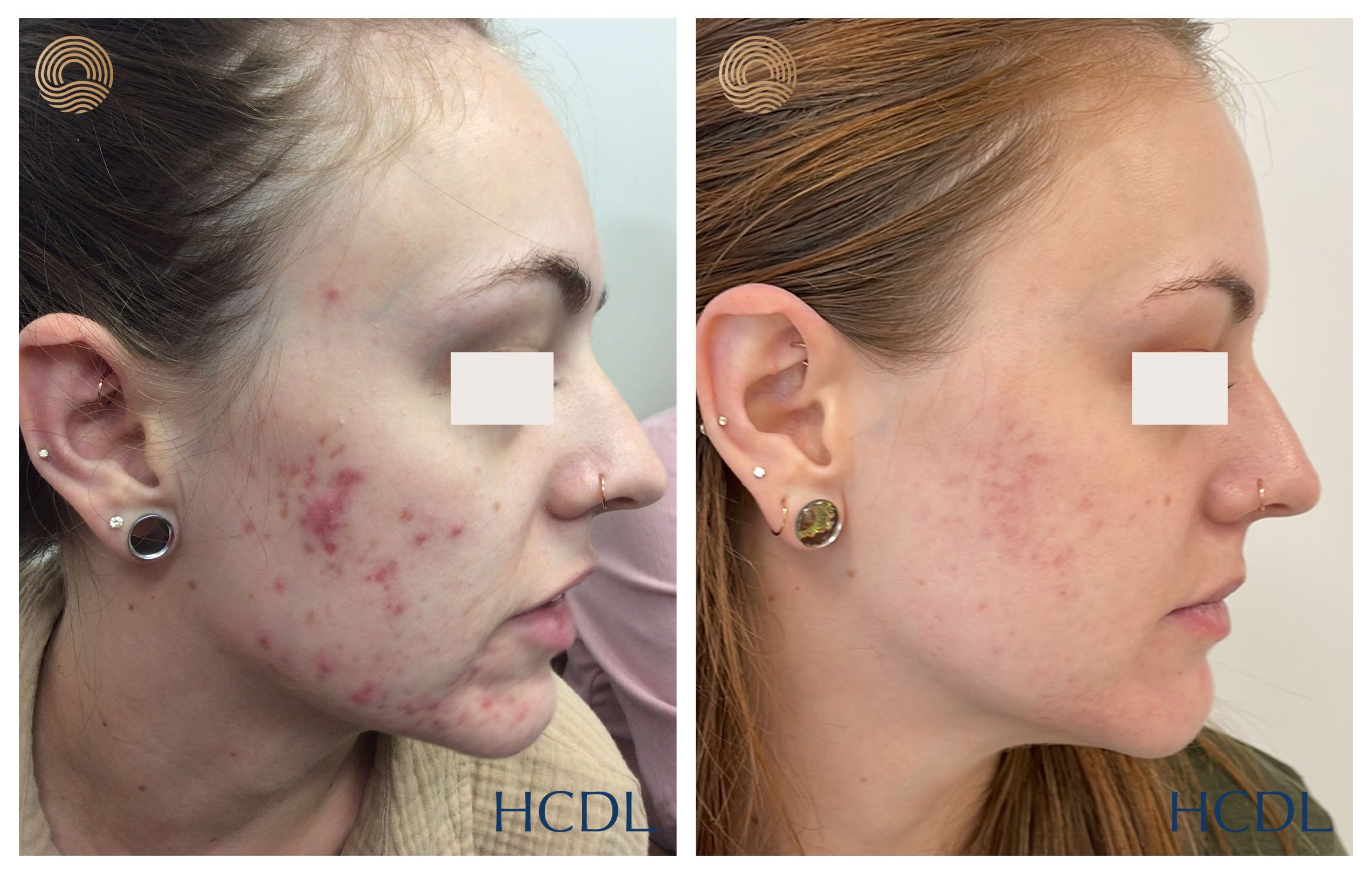 Laser Genesis for acne, scarring, redness & skin rejuventation | Best Results | Dermatology led — Hunter Dermatology & Laser | Newcastle Dermatologists