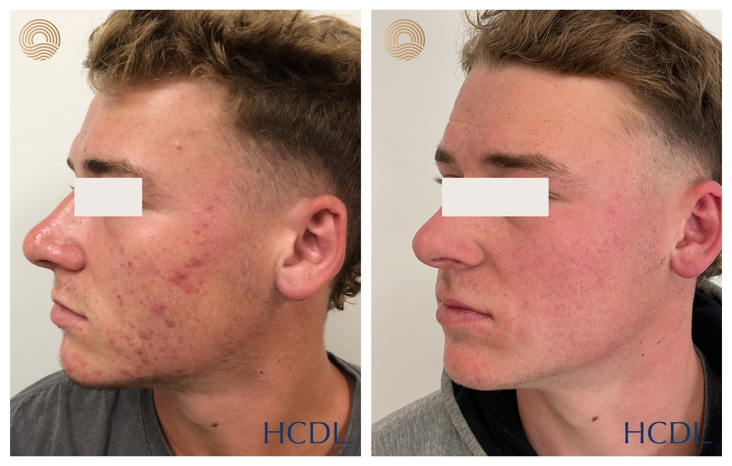Combined medical and laser management after 6 months