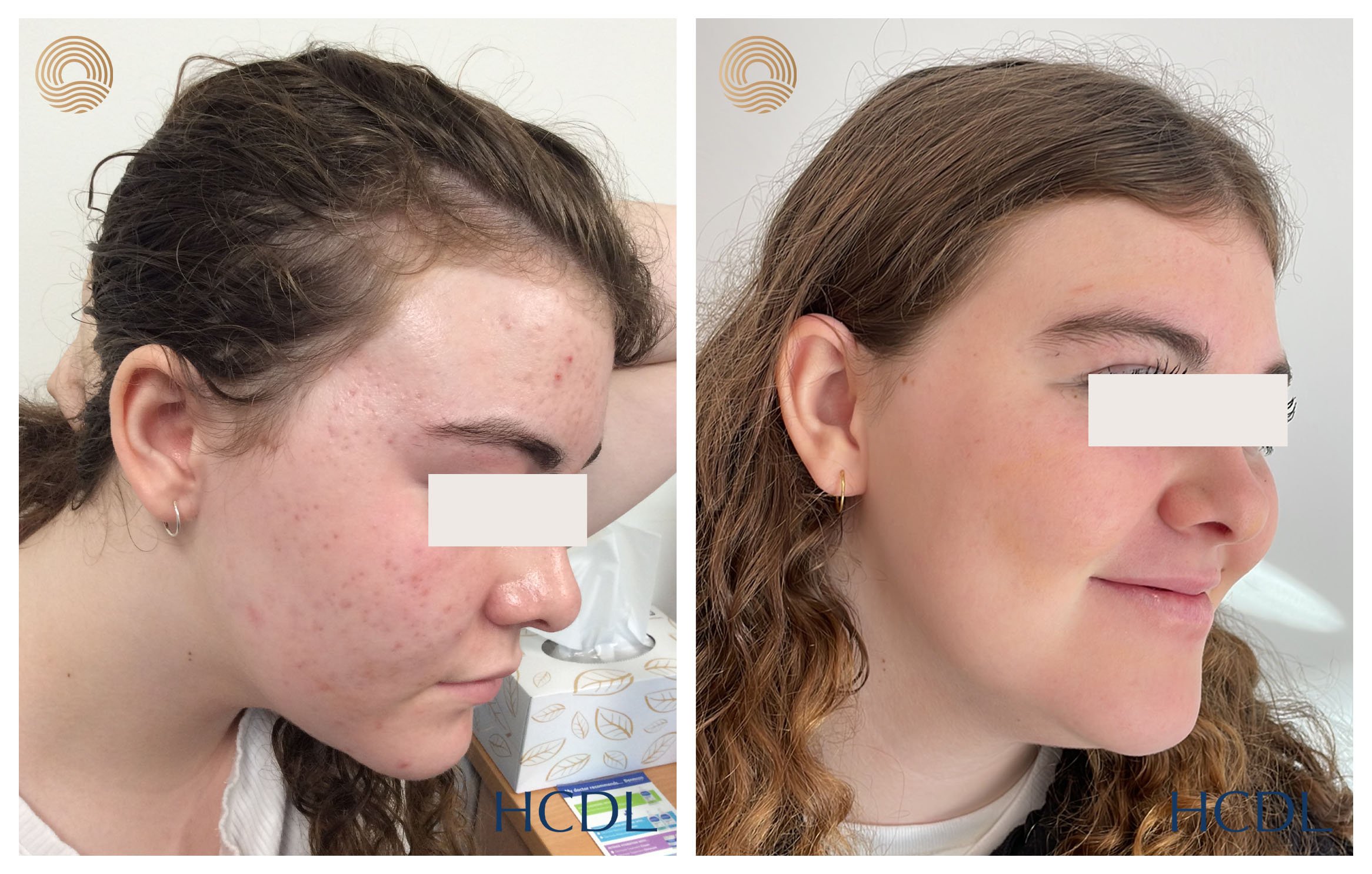 Combined medical and laser management after 10 months
