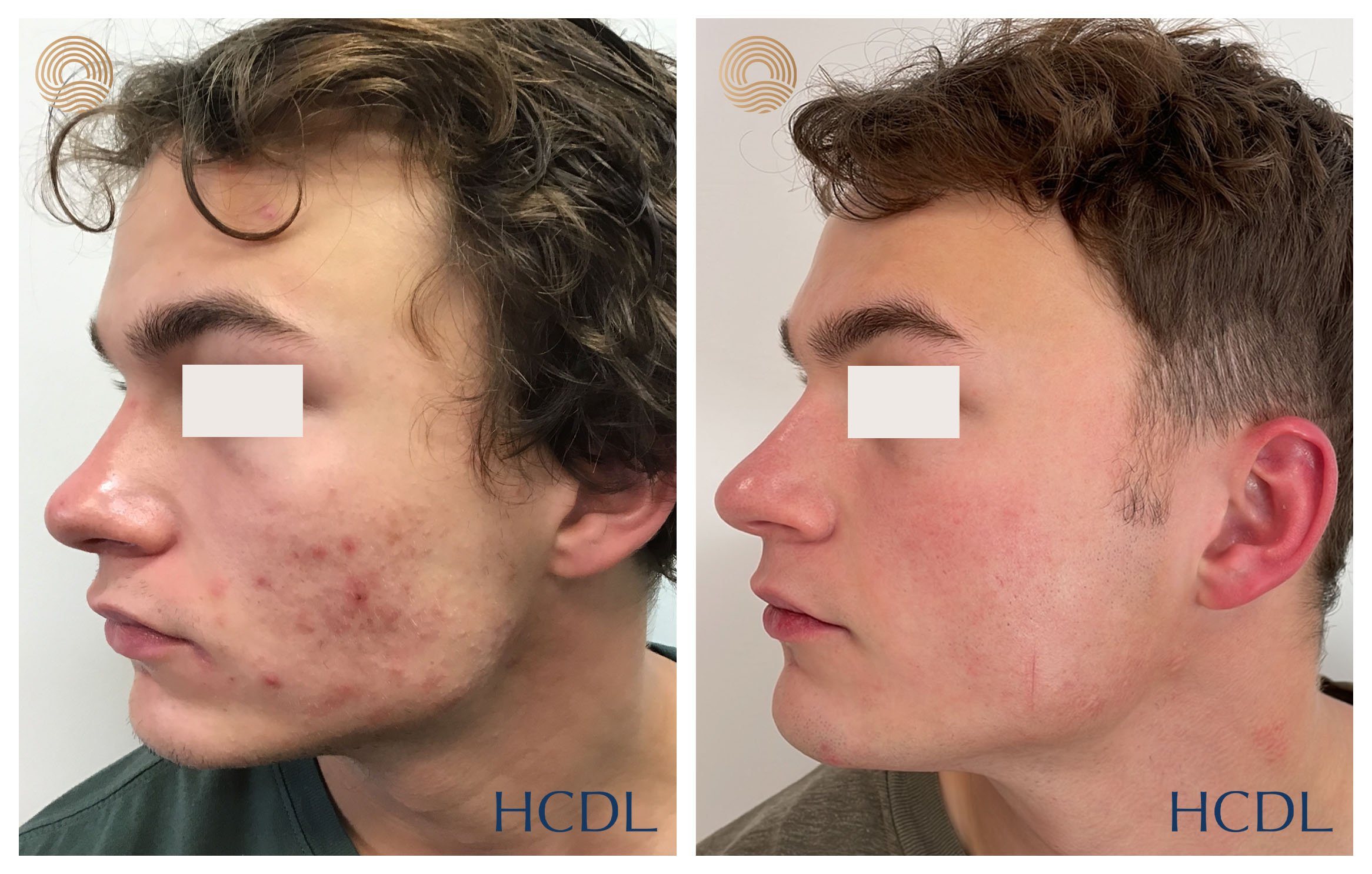Combined medical and laser management after 12 months