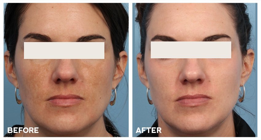 Hunter Coast Dermatology+Before+After+Spectra+patient+1.jpg