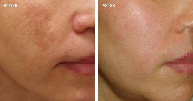 Hunter Coast Dermatology+Before+After+Spectra+patient+2.jpg