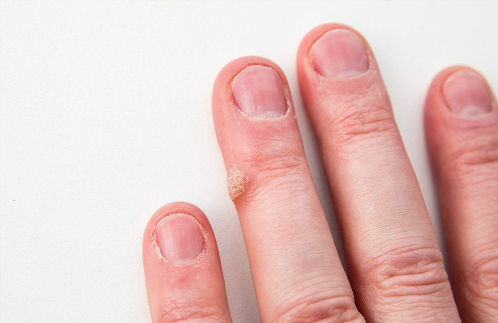 Skin Infections and Warts — Hunter Coast Dermatology & Laser | Newcastle  Dermatologists