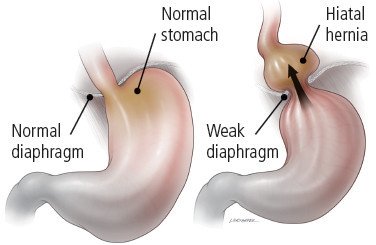 New Patient Resource: Understanding Hiatus Hernia Surgery 