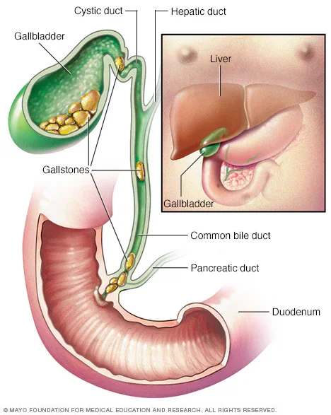 Gallstones After Rapid Weight Loss: Symptoms and Gallbladder Surgery