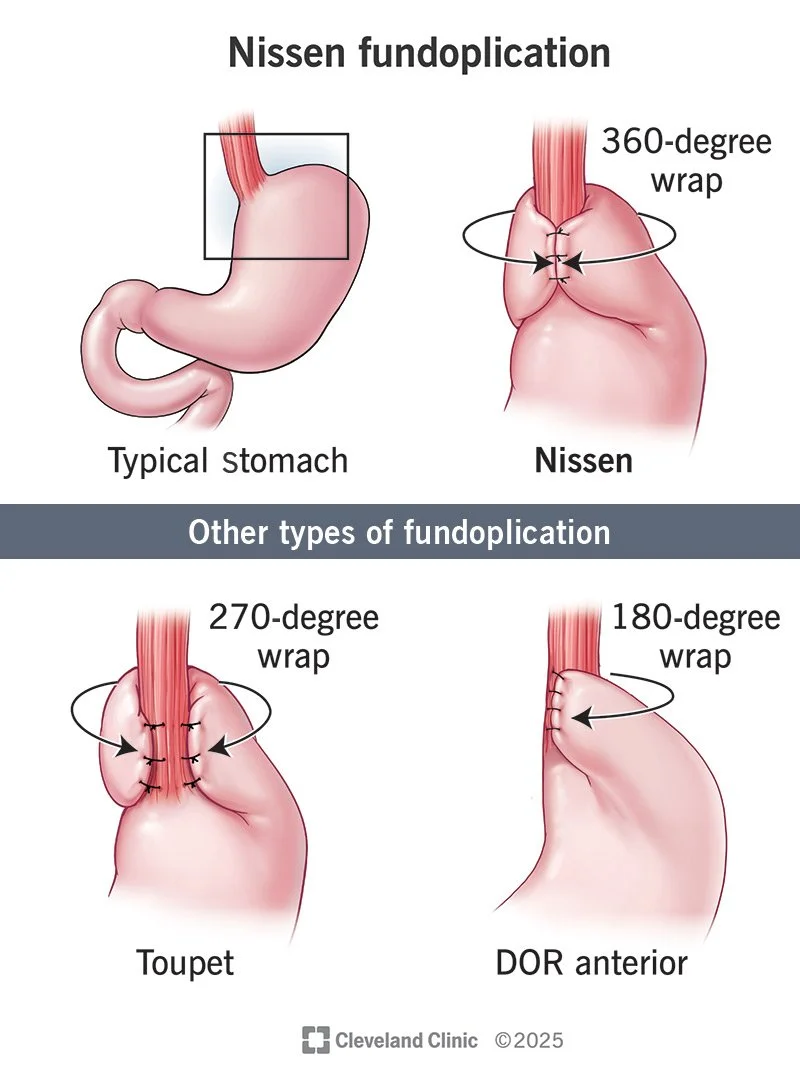 Reflux Surgery and Fundoplication: What Does Research Tell Us?