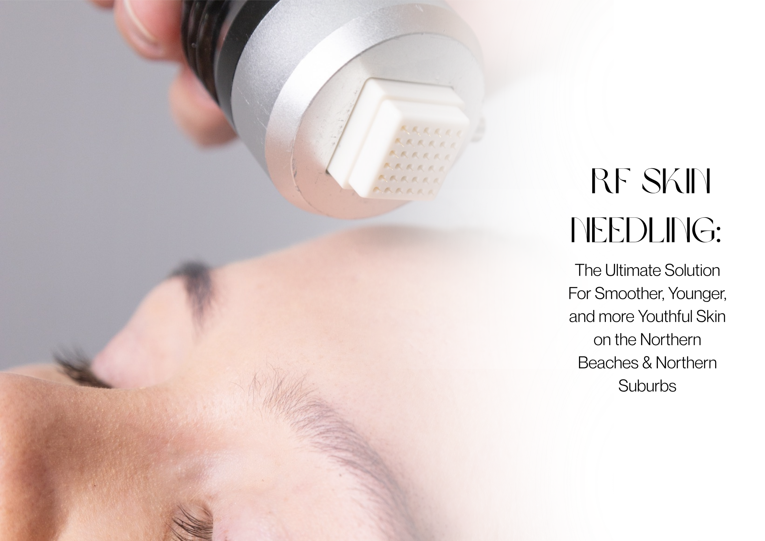 RF Skin Needling: The Ultimate Solution for Smoother, Younger, and Youthful Skin on the Northern Beaches &amp; Northern Suburbs
