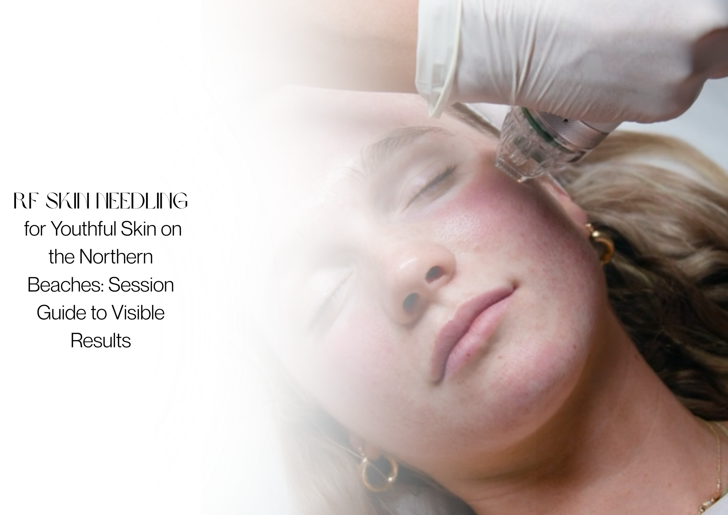 RF Skin Needling for Youthful Skin on the Northern Beaches: Session Guide to Visible Results
