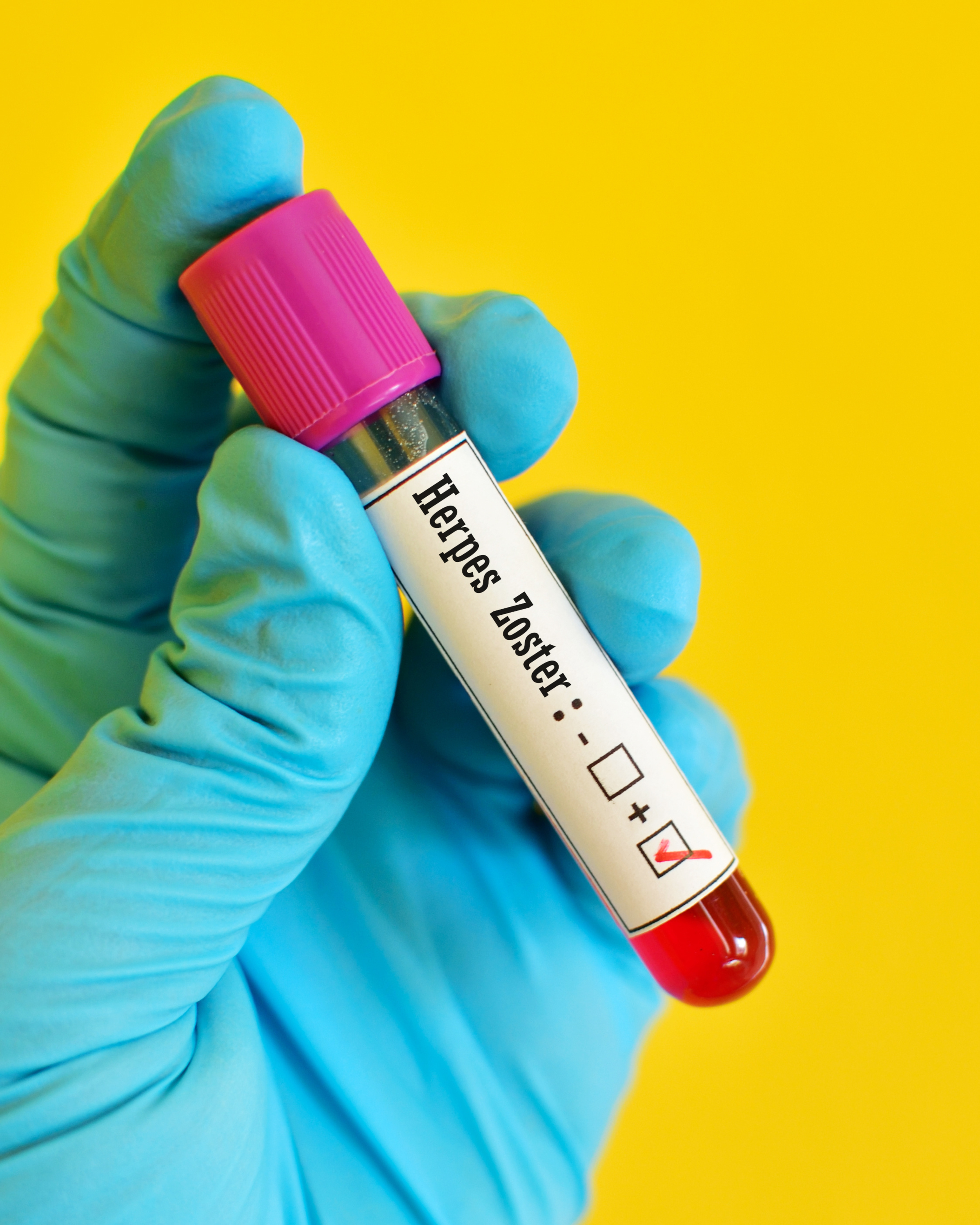 Herpes Zoster: Entenda a Doença e o Risco