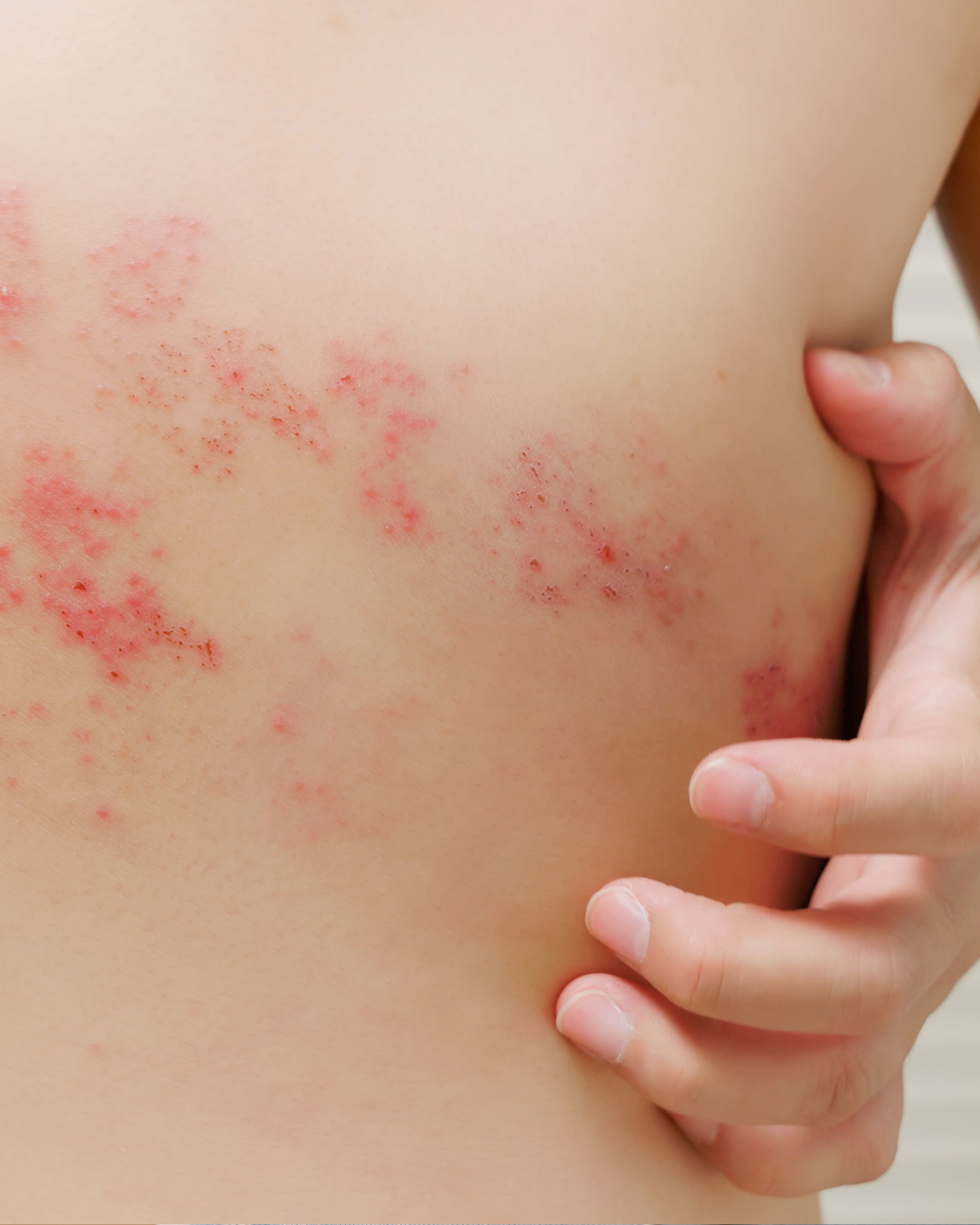 Herpes Zoster: Entenda a Doença e o Risco