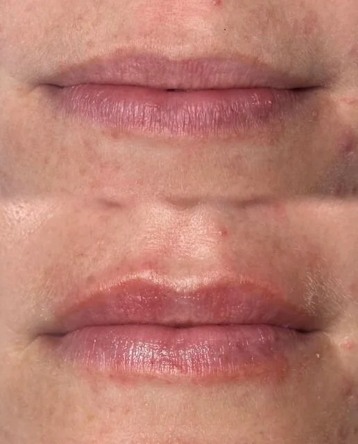Hyaluron Pen Lip Enhancement — Wildflower Aesthetics FL